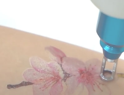 Tattoo removal