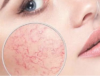 Vascular Lesions